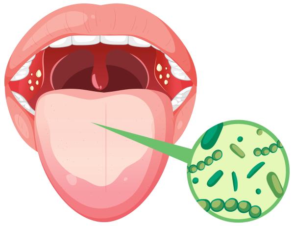 Sintomas de H. Pylori na boca e na língua - Sintomas mais comuns de H. Pylori na boca e na língua