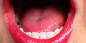 Tratamento caseiro para mucocele labial