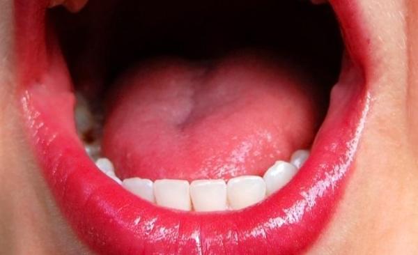 Tratamento caseiro para mucocele labial