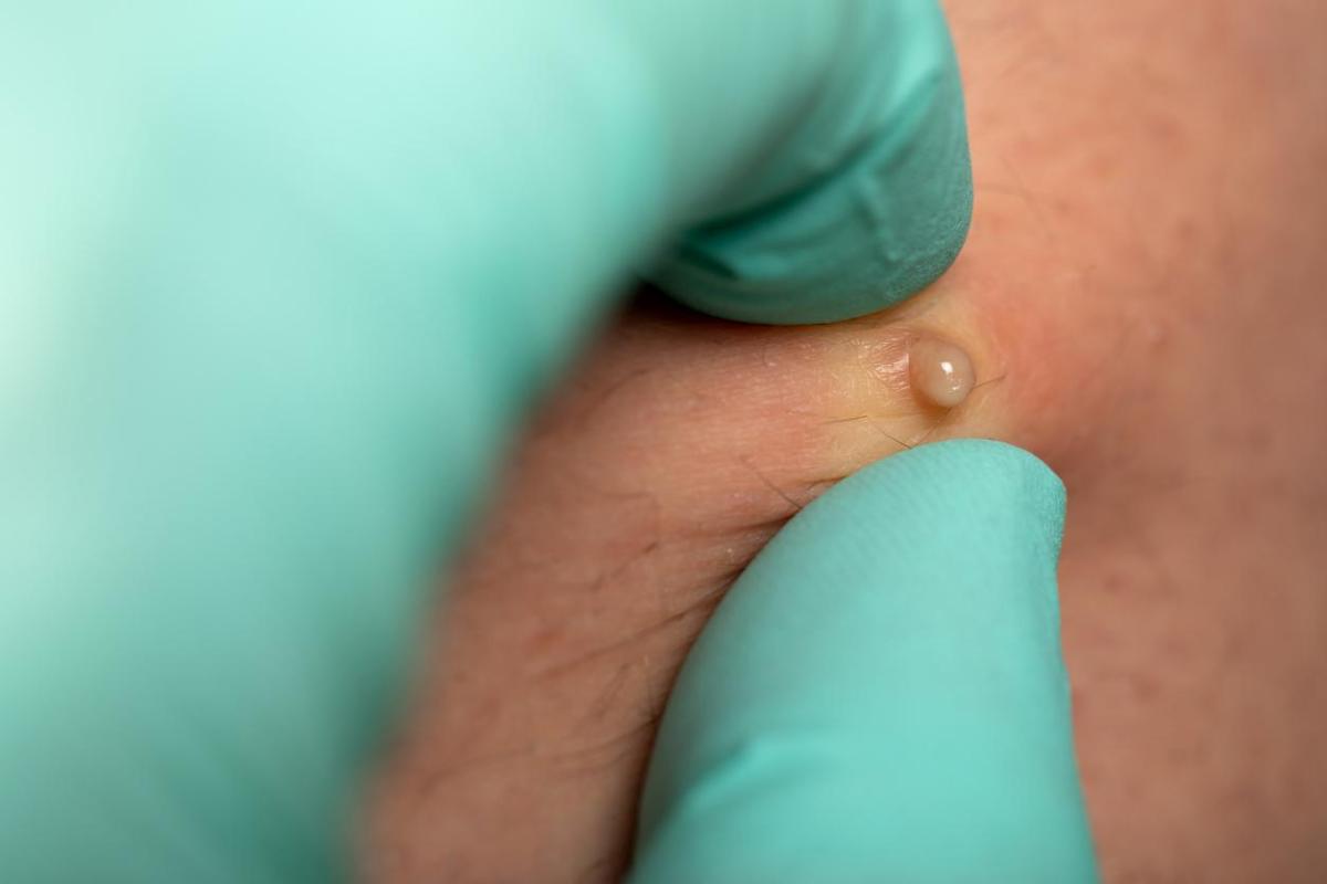 Como tratar a foliculite nas nádegas