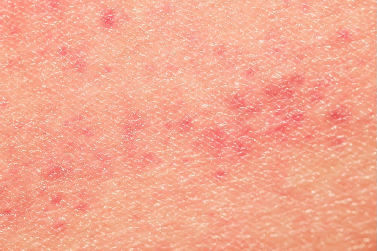 Manchas vermelhas na pele relacionadas ao estresse: causas e tratamento